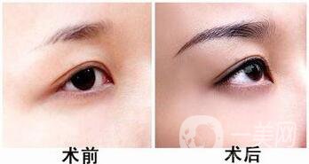 自體脂肪隆眉弓多少錢