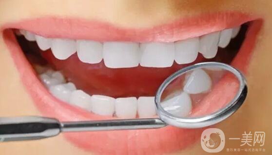 皓齒美白牙齒多少錢