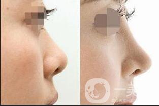 假體隆鼻后*果