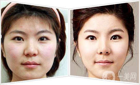 面部吸脂*果圖 面部吸脂注意事項(xiàng)