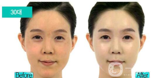 激光祛斑價格表 激光祛斑有副作用嗎