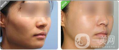 顴骨顴弓貴嗎,顴骨顴弓注意事項(xiàng)