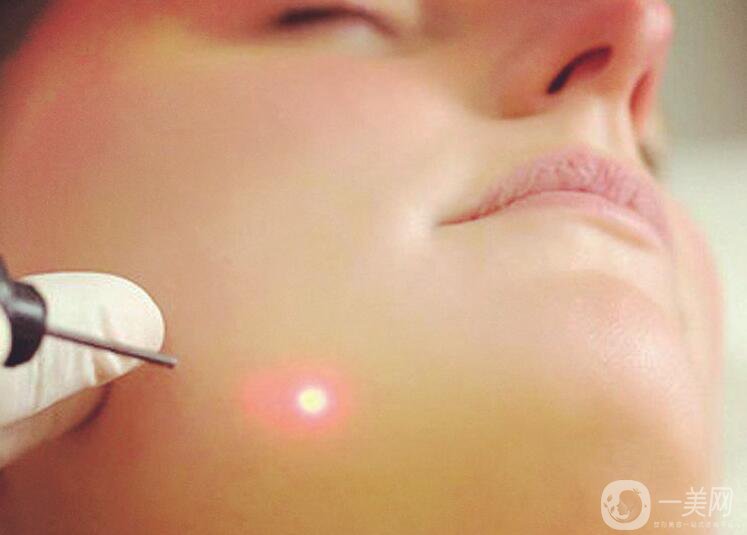 像素激光祛疤價格,像素激光祛疤貴嗎