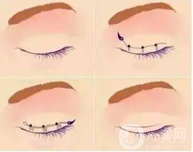 韓式三點(diǎn)雙眼皮價(jià)格, 韓式三點(diǎn)雙眼皮和埋線區(qū)別