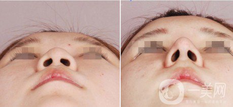 假體隆鼻整型術(shù)怎么樣 什么人不適合做假體隆鼻？