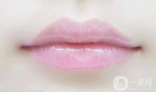 玻尿酸豐唇珠后需注意什么 該如何護理？