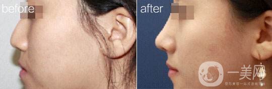 自然隆鼻 哪種隆鼻方式*自然 如何*放心地變美？