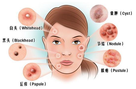痤瘡調(diào)節(jié)的*佳方法是什么呢?