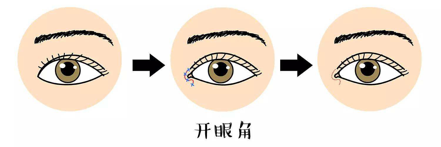開(kāi)眼角手術(shù)前后圖 開(kāi)眼角注意事項(xiàng)