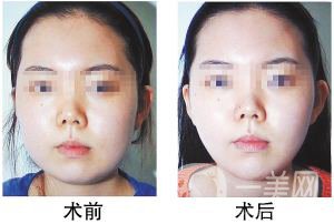 顴骨內(nèi)推貴嗎 顴骨內(nèi)推*果好不好