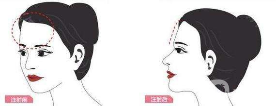 自體脂肪填充額頭貴嗎 自體脂肪填充額頭好不好