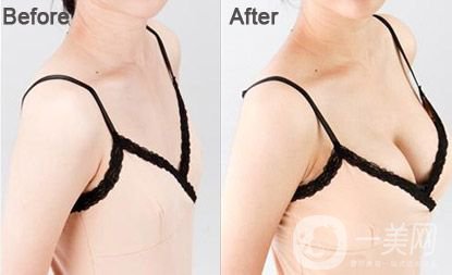 自體脂肪移植隆胸術(shù)保養(yǎng)方法 隆胸術(shù)*果好不好
