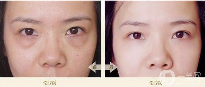 內(nèi)吸去眼袋能保持幾年