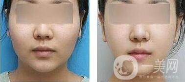 臉部溶脂后注意事項(xiàng)