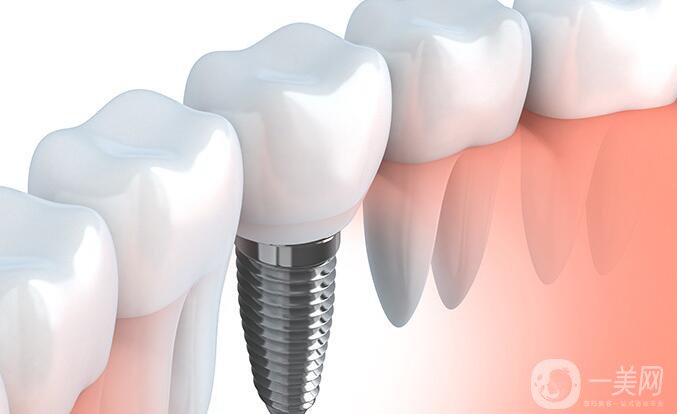 種植牙和鑲牙哪個(gè)更好