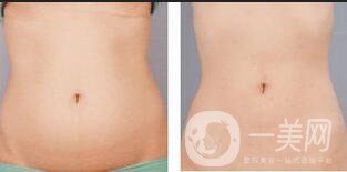 腰腹吸脂多久消腫