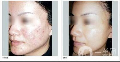 磨皮祛痘坑前后:激光磨皮祛痘坑*果嗎？