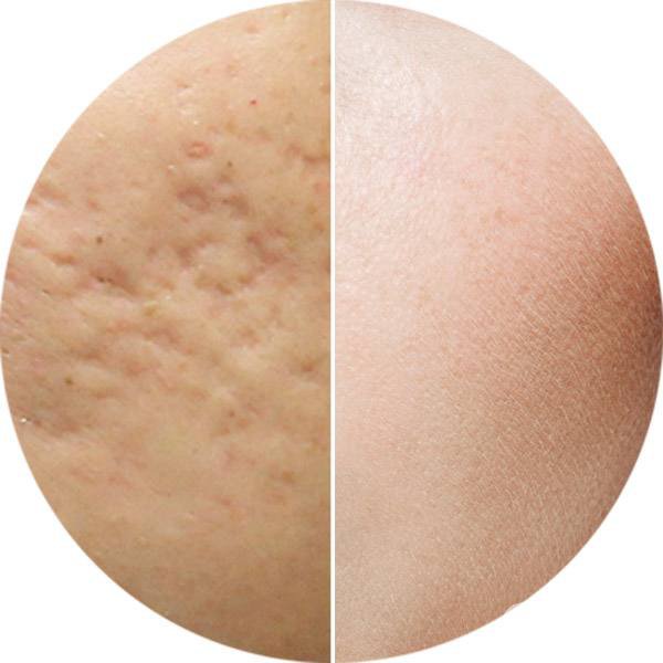 微針去痘坑*嗎 微針去痘坑副作用