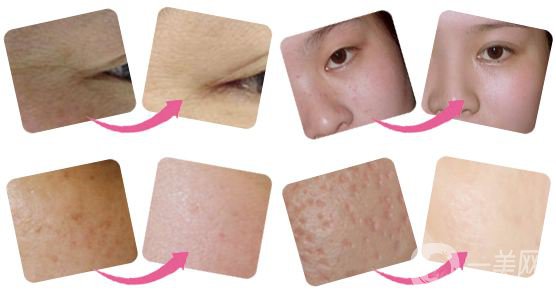 光子嫩膚的價(jià)格 光子嫩膚的功*有哪些