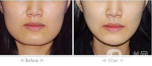 磨腮削骨后遺癥有哪些 磨腮削骨注意事項