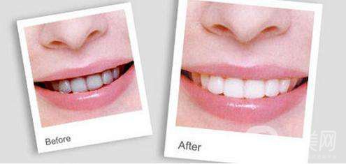 超聲波洗牙的危害 超聲波洗牙的原理