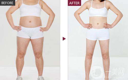 沃斯堡冰雕如何減少頑固脂肪 *果好不好?