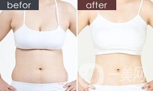 小腹肌成形術(shù)風(fēng)險(xiǎn)有多大 小腹肌成形術(shù)的恢復(fù)時間