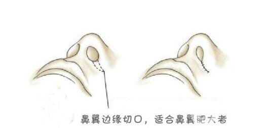 鼻翼怎么變小竅門 鼻翼變小的方法