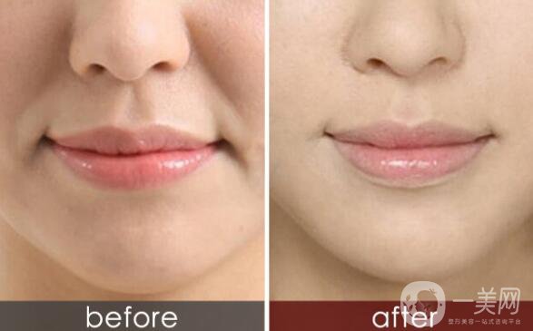 有法令紋怎么辦,法令紋怎么消除