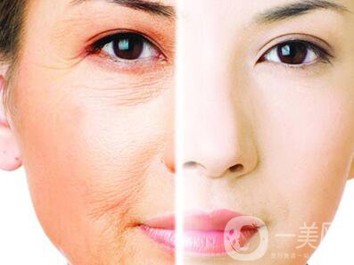 光子嫩膚副作用