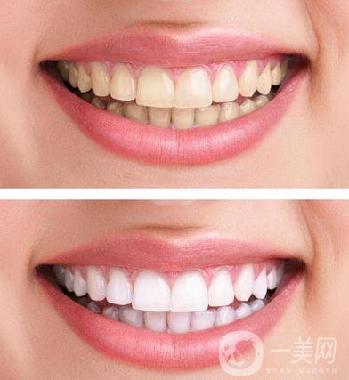 潔牙多少錢 價格高嗎？