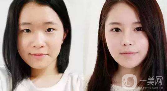 什么眼皮不能割雙眼皮手術(shù) 割雙眼皮注意事項