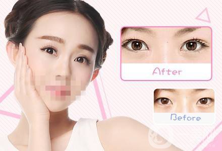 什么眼皮不能割雙眼皮手術(shù) 割雙眼皮注意事項