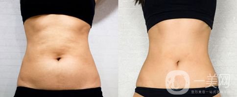 沃斯堡腹壁成形術(shù)風(fēng)險大嗎 多久恢復(fù)呢