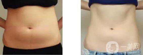 沃斯堡腹壁成形術(shù)風(fēng)險大嗎 多久恢復(fù)呢