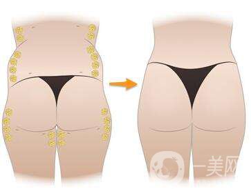 臀部強(qiáng)化手術(shù)多久恢復(fù) 臀部強(qiáng)化注意事項(xiàng)