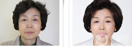 整容手術(shù)要多久時(shí)間 整容手術(shù)風(fēng)險(xiǎn)有多大