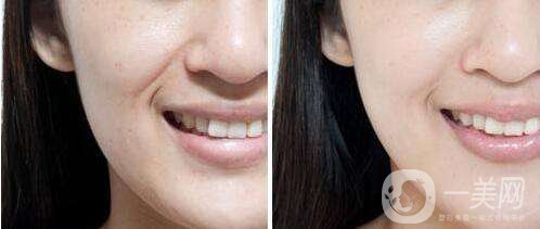 法令紋深怎么辦 法令紋深如何消除