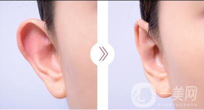 招風(fēng)耳手術(shù)多少錢