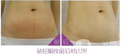 腹壁成形術(shù)風險,腹壁成形術(shù)注意事項