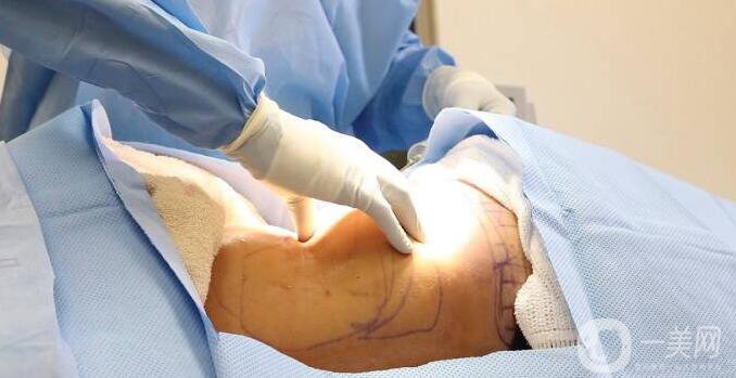 抽脂適宜人群,抽脂注意事項