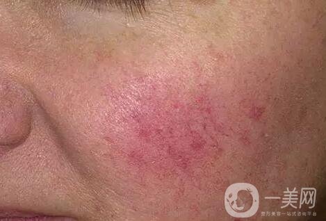 臉上長紅血絲怎么辦?去紅血絲攻略親測*