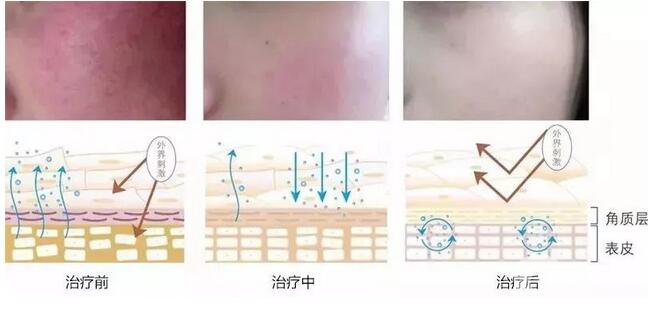 臉上長紅血絲怎么辦?去紅血絲攻略親測*