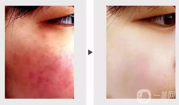 臉上長紅血絲怎么辦?去紅血絲攻略親測*
