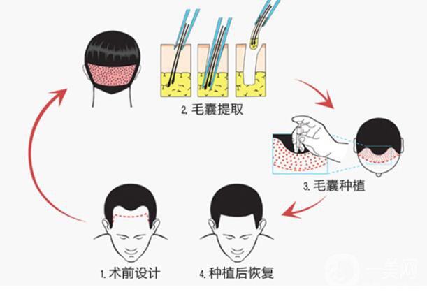 植發(fā)的*果是*性的嗎 它的原理是什么？