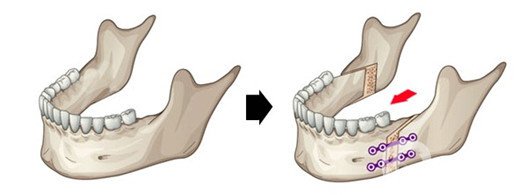 雙頜前突是什么 凸嘴不好看該怎么辦？