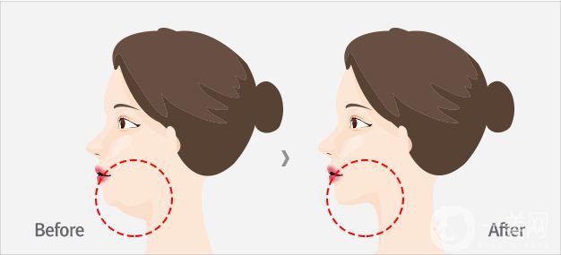 雙下巴怎么形成的 如何去掉雙下巴? 
