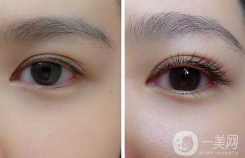 種睫毛多少錢 種睫毛手術(shù)時間是多久