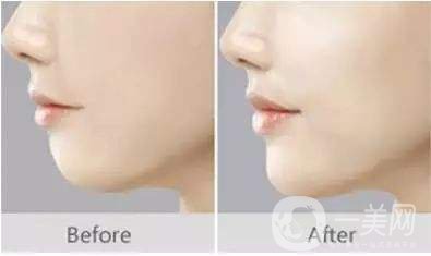 做下巴好不好 做下巴整形手術(shù)的方法