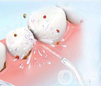 洗牙的價(jià)格是多少 洗牙后注意事項(xiàng)